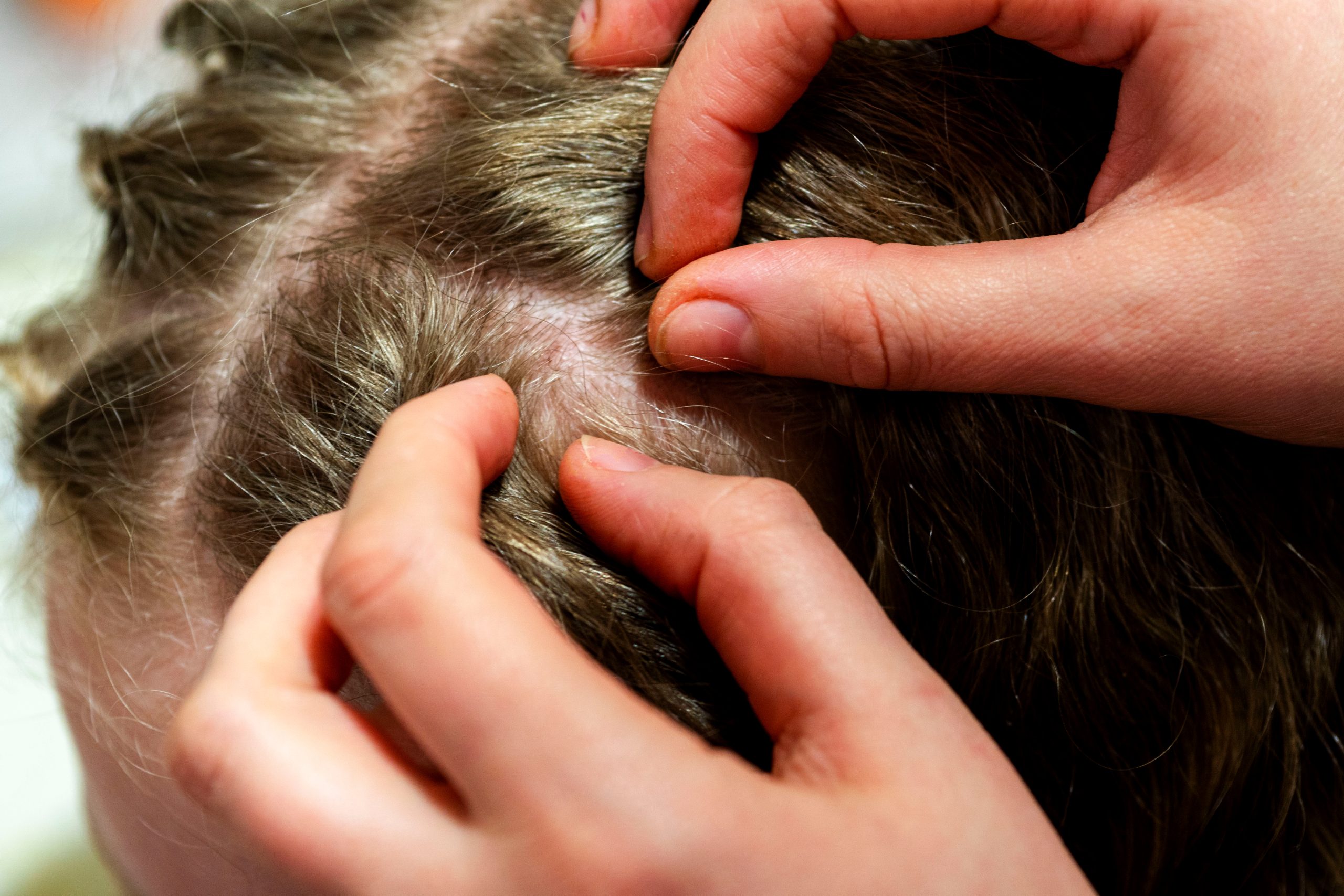 How to Check Your Child’s Head for Lice: A Step-by-Step Guide
