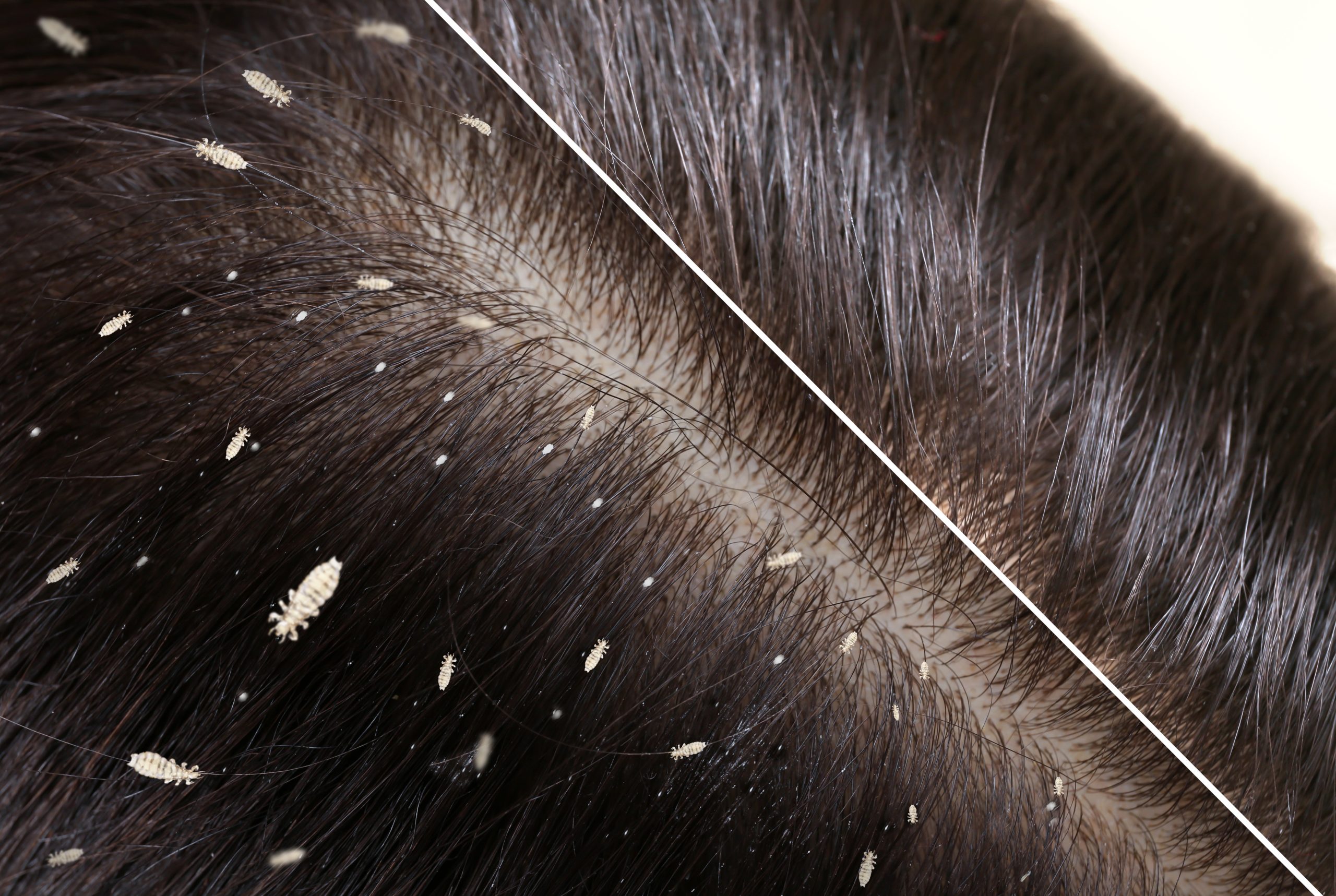 Collage showing woman's hair before and after lice treatment, closeup. Suffering from pediculosis