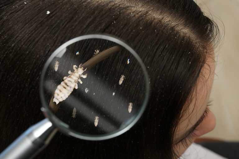 Illustrative close-up of dark hair with enlarged lice shown through a magnifying glass.