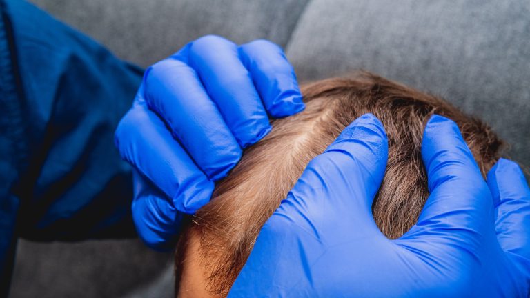 Blue-gloved hands parting short hair to inspect the scalp