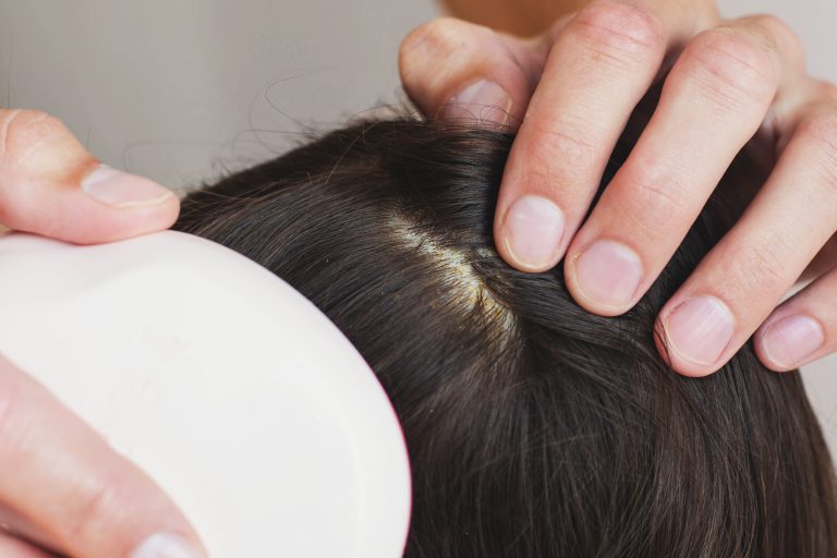 Hands parting dark hair to reveal pale flakes along the scalp.
