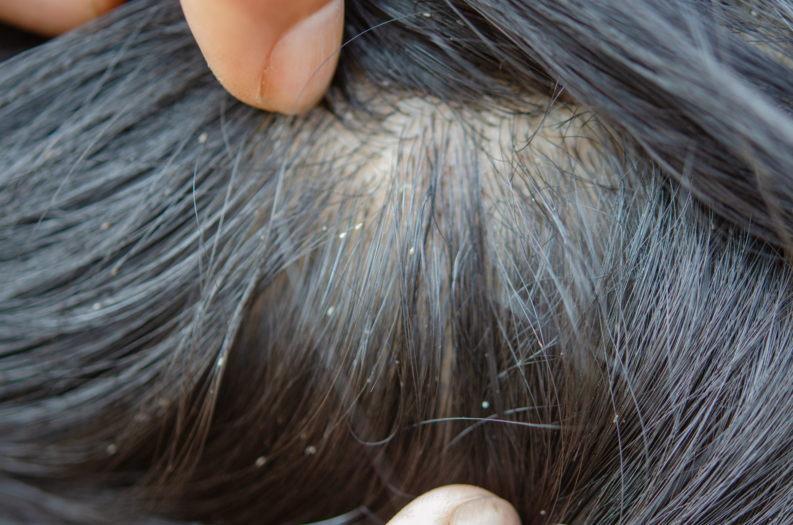 Close-up louse egg attached to a hair strand