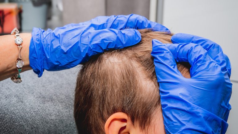 Stripping Every Bed Won’t End Your Lice Problem